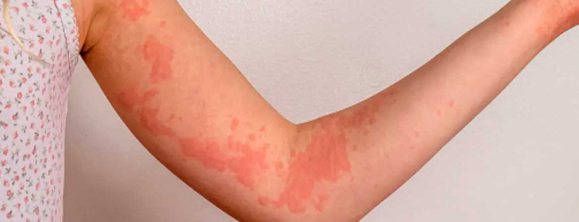 o-que-e-alergia