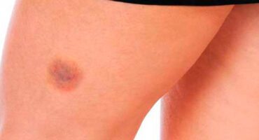 manchas-roxas-no-corpo