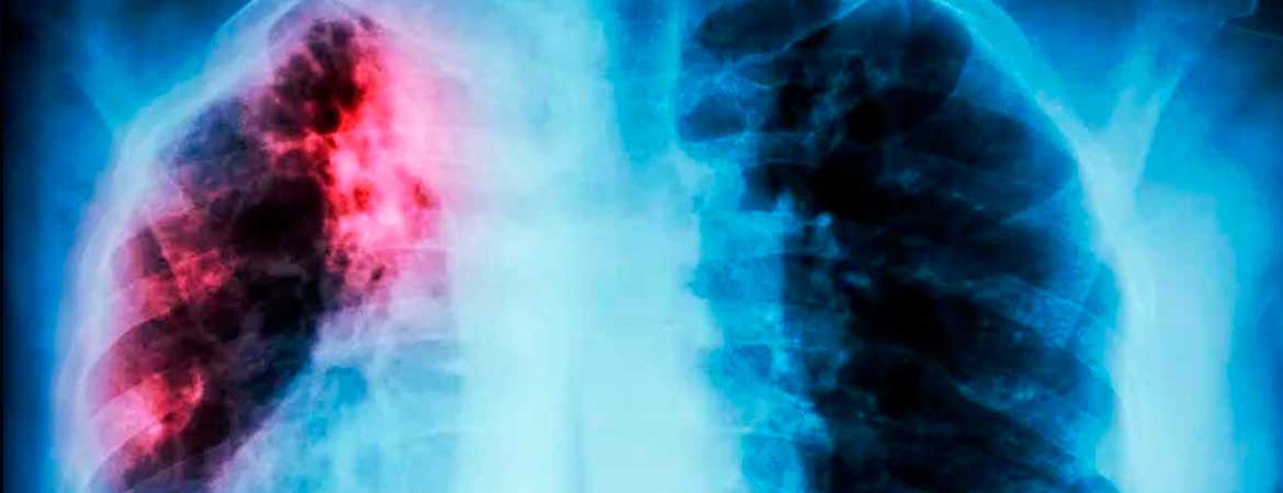 tuberculose
