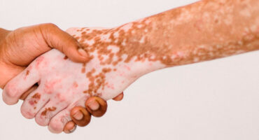 vitiligo-como-se-cuidar